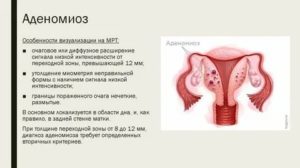 Беременность при эндометриозе лечение жанином