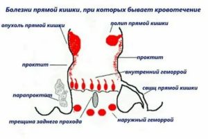 Если при простатите идет кровь из заднего прохода