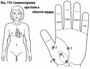 Семянотерапия су джок при бесплодии