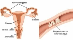 Семена льна при миоме и эндометриозе отзывы