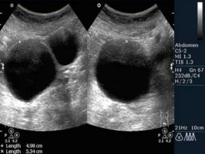 На узи объемное образование правого яичника