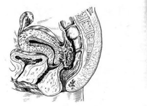 Иссечение ретроцервикального эндометриоза что это такое