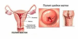 Что такое киста шейки матки и полипы как ее лечить