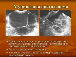 Что такое киста правого яичника папиллярная цистаденома