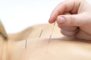 Можно ли делать иглоукалывание при эндометриозе