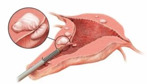 Что такое гистероскопия при субсерозной миоме матки