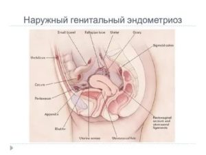 Наружный генитальный эндометриоз 2 степени что это