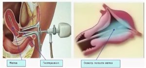 Гистероскопия матки при эндометриозе нужна ли операция