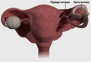 Как избавиться от фолликулярной кисты яичника народными средствами