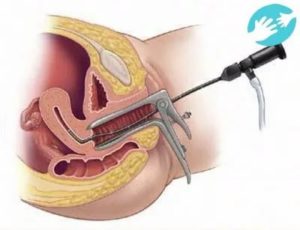 После гистероскопия матки задержка