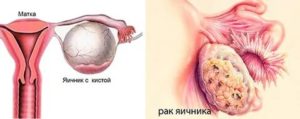 Чем отличается раковая опухоль от кисты яичника