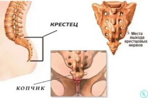 Боли в области копчика при эндометриозе