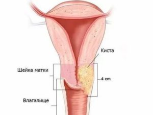 Как лечить прополисом от кисты на шейке матки