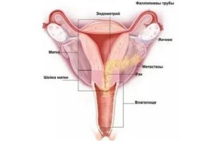 Причины рака матки эзотерика