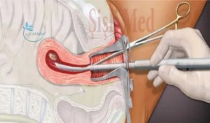 Сколько идут выделения после выскабливания при эндометриозе