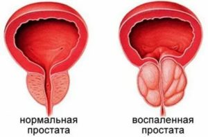 Эшерихия коли в простате лечение