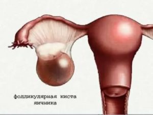 Сколько может не рассасываться фолликулярная киста яичника