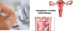 Орально генитальный контакт кандидоз
