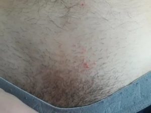 Мазь красные пятна на лобке