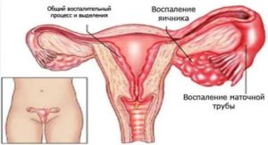 Может ли не быть месячных при воспалении яичников у женщин