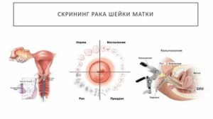 Запор при раке шейки матки что делать