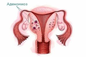 Эндометриоз аденомиоз миому полипы эндометрия