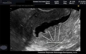 Что значит на узи отражение от эндометрия