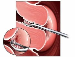 Какие должны быть месячные после диагностического выскабливания