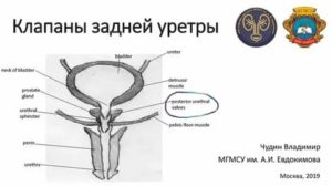 Диагностика клапана задней уретры