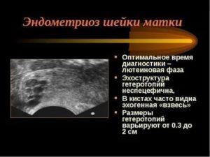 Субэпителиальный эндометриоз шейки матки какое лечение эффективно