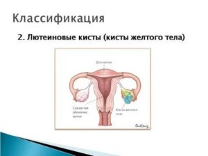 Что значит лютеиновая киста яичника
