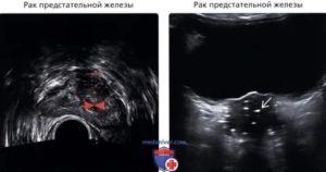 Гипоэхогенное образование предстательной железы это рак или нет