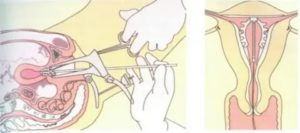 Препараты для восстановления матки после удаления спирали