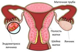 Внутренний эндометриоз мультифолликулярных яичников что это такое