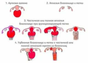 Лечение недоразвития полового члена препарат