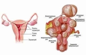 Можно ли при эндометриозе и миоме посещать баню