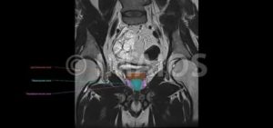 Анатомия предстательной железы по мрт