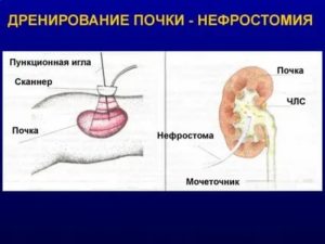 Нефростома в почке при раке шейки матки