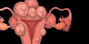 Миома матки симптомы и рак шейки матки