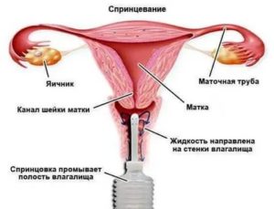 Спринцевание квасцами при молочнице отзывы