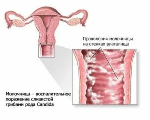 Может ли партнер быть носителем молочницы