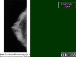 Гематома молочной железы лечение препараты