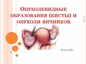 Чем отличается раковая опухоль от кисты яичника