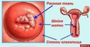 Какими препаратами лечить кондиломы на шейке матки
