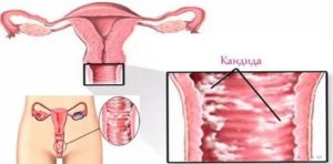 Трещины на клиторе молочница у
