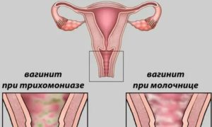 Покалывание в области матки при молочнице