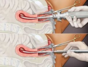 После гистероскопии ставить вагинальные свечи
