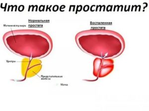 Что такое хронический простатит при таком диагнозе могут быть дети