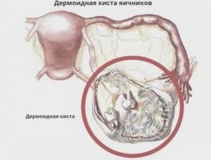Можно ли родить с дермоидной кистой яичника