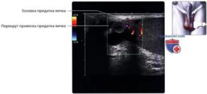 Нормальные размеры придатка яичка на узи